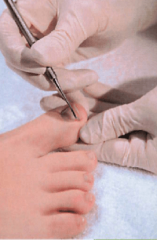 巻き爪のワイヤー治療の爪を整える
