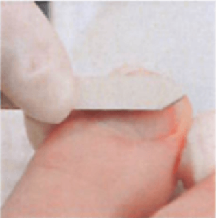 巻き爪のワイヤー治療の爪をやすりで整える