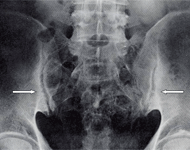 仙腸関節のレントゲン画像