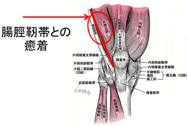 腸脛靭帯と外側広筋の癒着