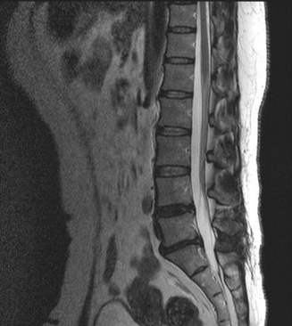 腰部脊柱管狭窄症と比較するための正常MRI