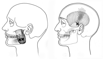 側頭筋と咬筋の関連痛のイラスト