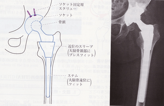 股関節の手術の写真