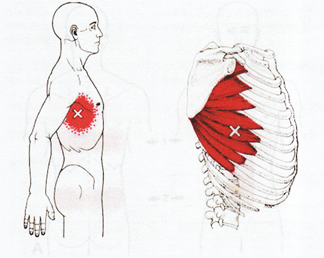 肋間神経痛の関連痛写真