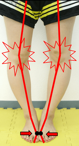 外反母趾が原因のひざ痛イラスト