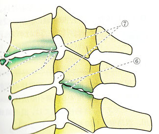 変形性腰椎症の図